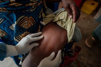 Le virus mpox se propage dans certaines régions d’Afrique. (Photo : Organisation mondiale de la santé via X.)