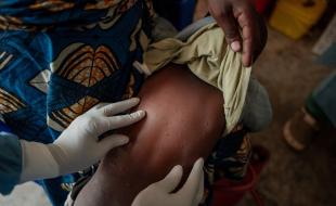 Le virus mpox se propage dans certaines régions d’Afrique. (Photo : Organisation mondiale de la santé via X.)